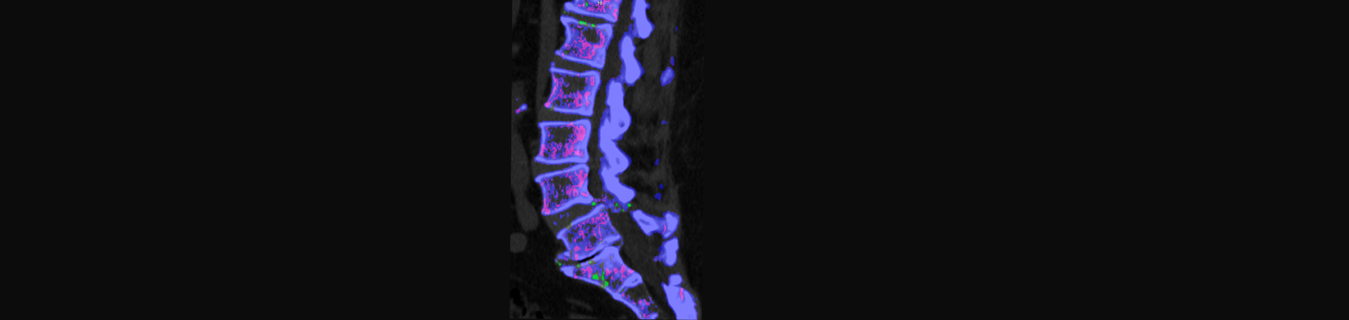 Vancouver Disc Centers is aware that inflammatory spinal gout is a differential diagnosis to consider for patients who present with back pain and other spine related symptoms.