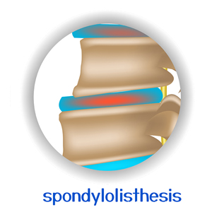 picture of Vancouver spondylolisthesis